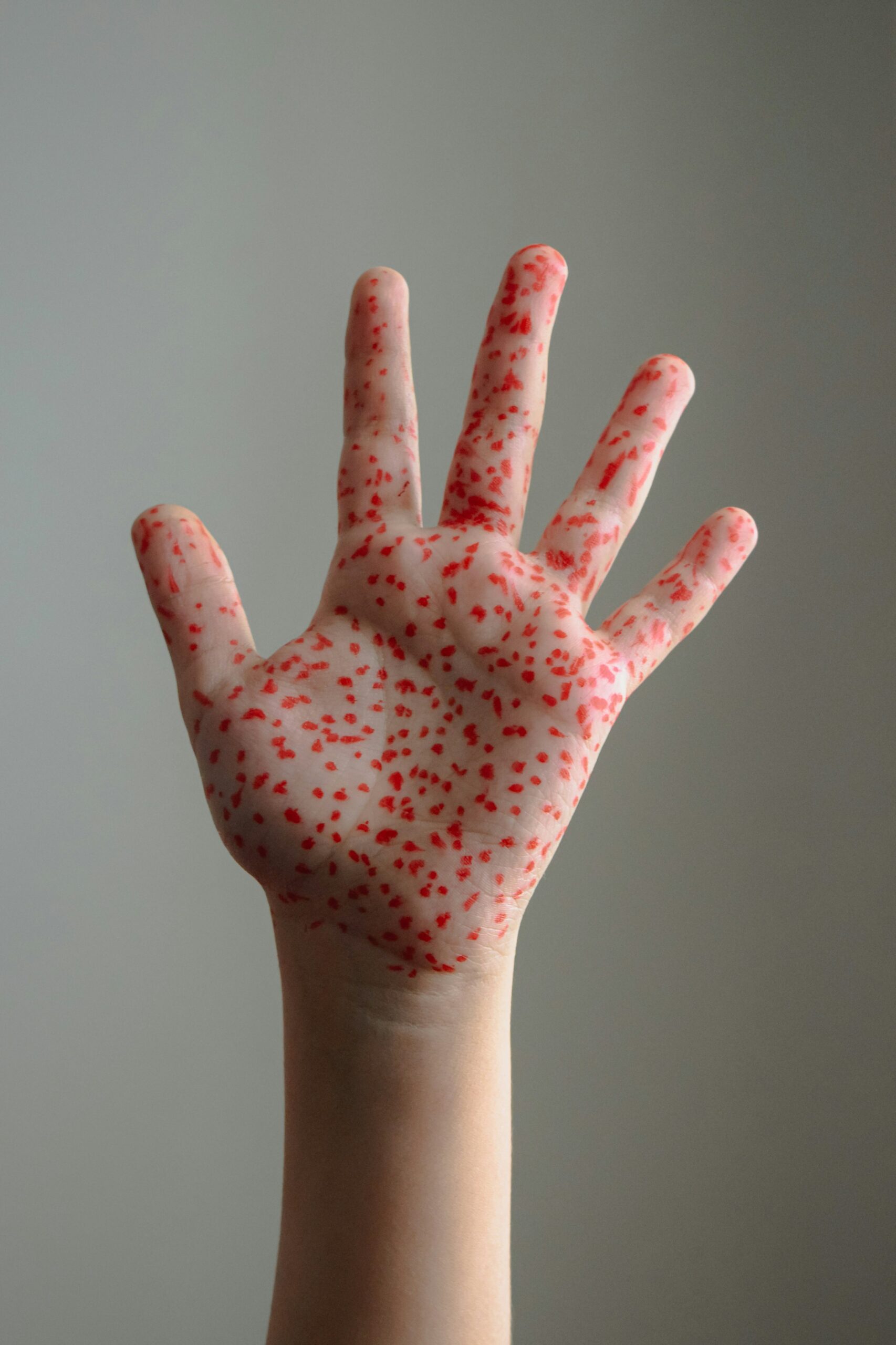 Global measles deaths have dropped by about 88 % since 2000 thanks to vaccination campaigns, yet confirmed cases and outbreaks are increasing in many regions. Health experts urge keeping immunization up to date to stop spread and protect communities.